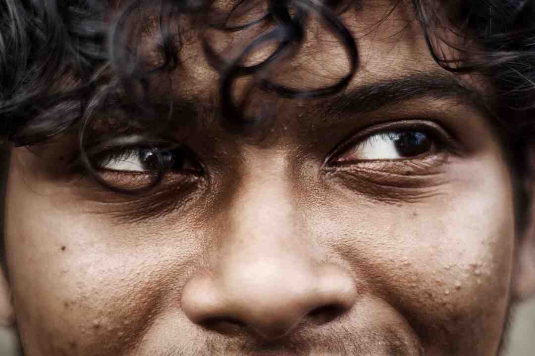 Pourquoi les asiatiques ont de l'acné ?